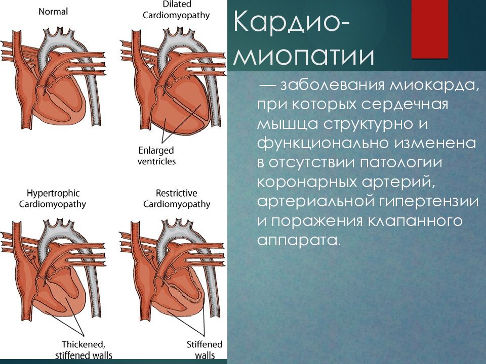 Кардиомиопатия сердца что это такое