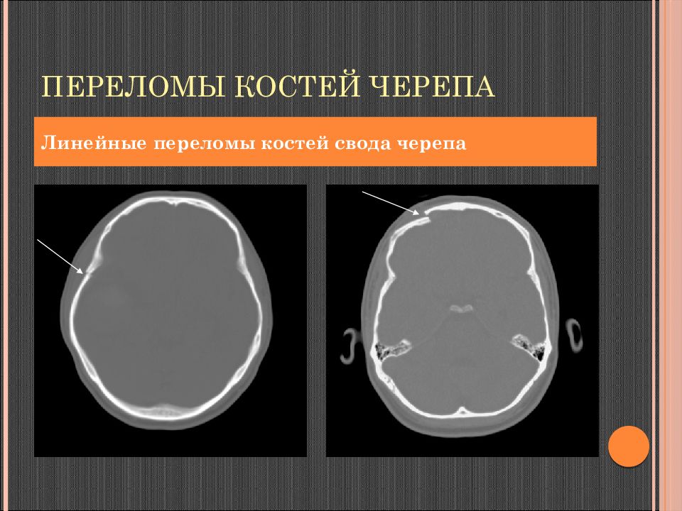 Перелом кости свода черепа. Линейный перелом костей свода черепа. Перелом костей свода черепа кт. Вдавленный перелом теменной кости кт. Перелом теменной кости черепа рентген.