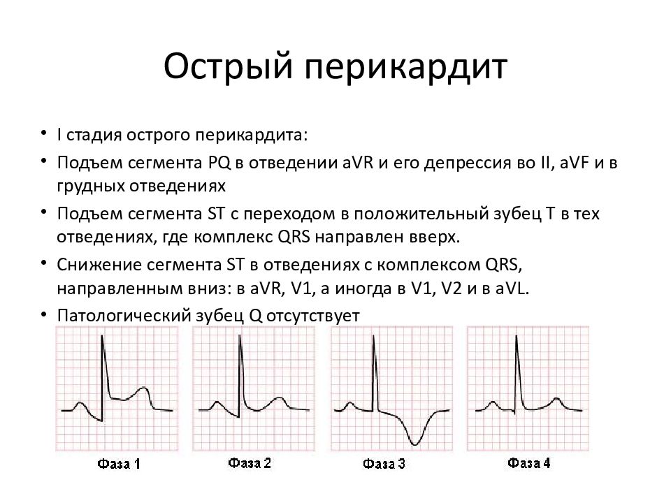 Конкордантный подъем сегмента. Конкордантный подъем сегмента St. Анализ сегмента St. Критерии подъема сегмента St. Продолжительность сегмента St.