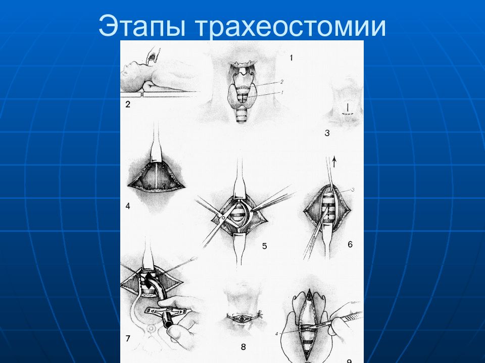 Трахеостомия. Трахеостомия топографическая анатомия этапы. Трахеостома Оперативная хирургия. Трахеостомия топографическая анатомия и Оперативная хирургия. Этапы операции трахеостомии.