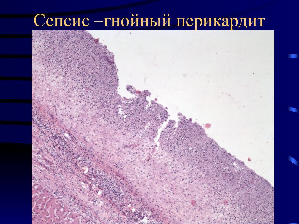 Патологическая анатомия сепсиса презентация