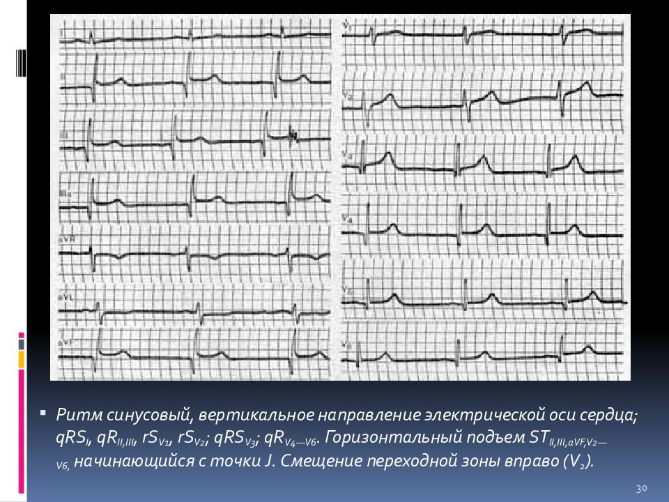 Реполяризация это в экг. Подъем сегмента St в i, II, AVF v5 v6. С-М ранней реполяризации желудочков на ЭКГ что это. Синдром ранней реполяризации желудочков на ЭКГ. Синдром ранний ранний реполяризации ЭКГ.