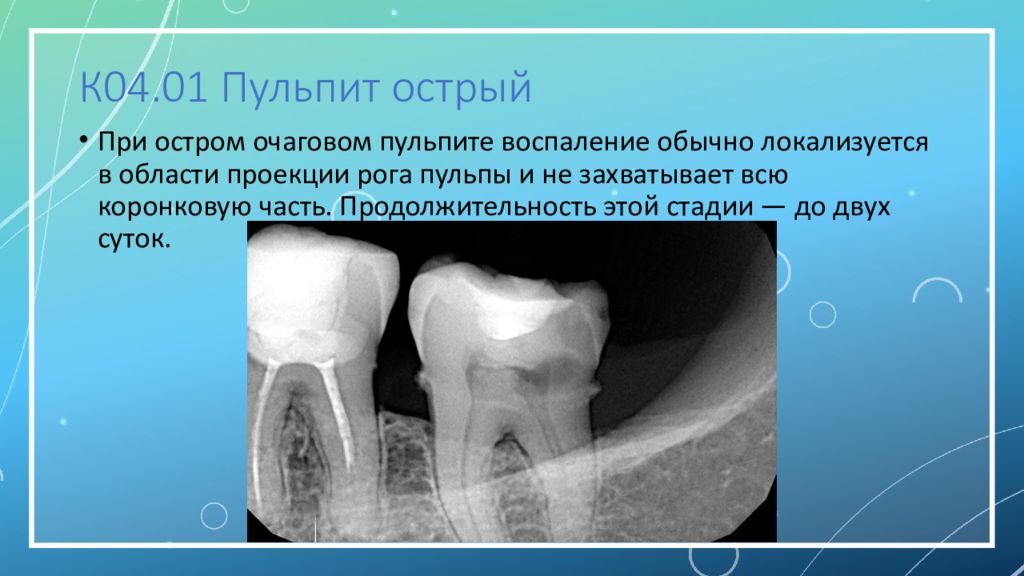 Очаговый пульпит