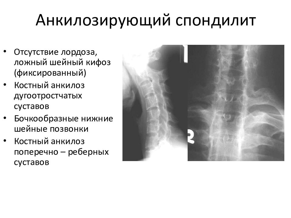 Анкилозирующий спондилит презентация