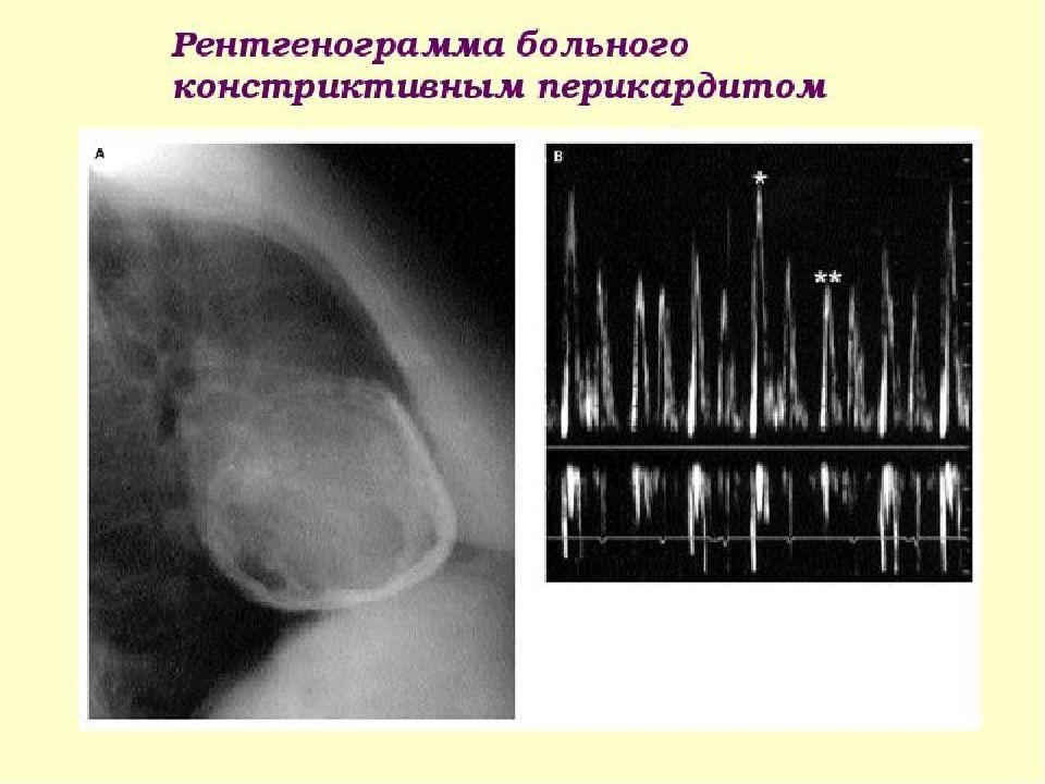 Туберкулезный перикардит презентация