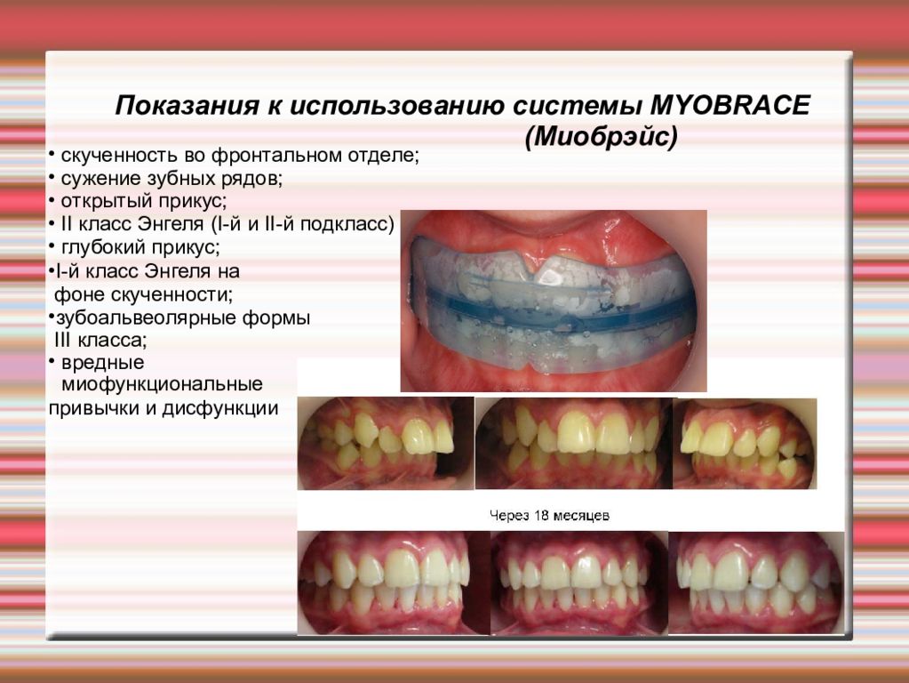 Классы окклюзии. Трансверзальные аномалии прикуса. Сагиттальныt аномалиb прикуса. Дистальная окклюзия вертикальная резцовая дизокклюзия. Сагиттальная резцовая дизокклюзия.