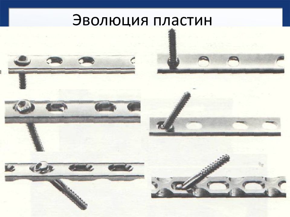 Другую пластину. DCP пластина для остеосинтеза. Типы пластин для остеосинтеза. Мостовидная пластина для остеосинтеза. Компрессионная пластина остеосинтез.