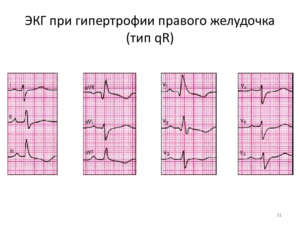Признаки гипертрофии левого желудочка на экг. ЭКГ при гипертрофии левого правого желудочка. Стеноз митрального отверстия ЭКГ.