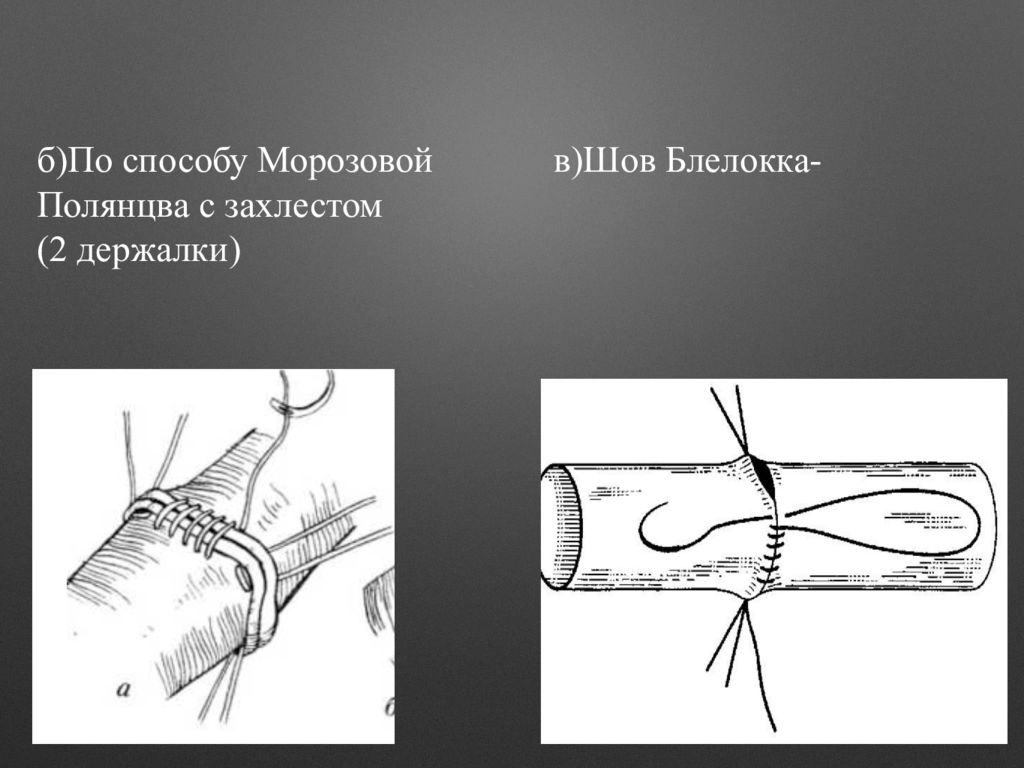 Техника ручного сосудистого шва по каррелю-морозовой. Шов по морозовой. Циркулярный сосудистый шов карреля. Сосудистый шов карреля и морозовой. Шов по морозовой.