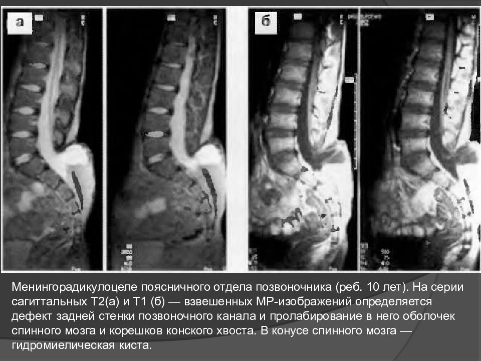 Мкб поясничного отдела позвоночника. Менингорадикулоцеле s2 что это. Спинномозговая грыжа менингорадикулоцеле. Менингоцеле на уровне s2, s3 позвонков это. Спинномозговая грыжа менингоцеле.