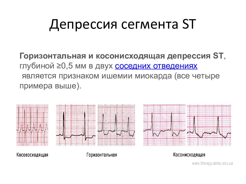 Депрессия сегмента st