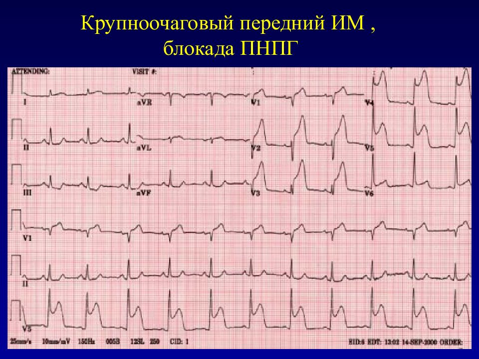 Правая ножка гиса. Полная трехпучковая блокада на ЭКГ. Трехпучковая блокада ножек пучка Гиса ЭКГ. Двухпучковая блокада ножек пучка Гиса. Блокада правой ножки Гиса Окс.