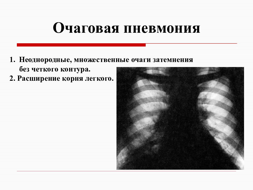 Микоплазменная пневмония признаки