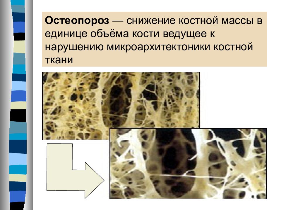 Инфекционные заболевания костной ткани. Уменьшение костной массы. Микроархитектоника костной ткани это. Сокращение костной массы. Нарушение микроархитектоники костной ткани.