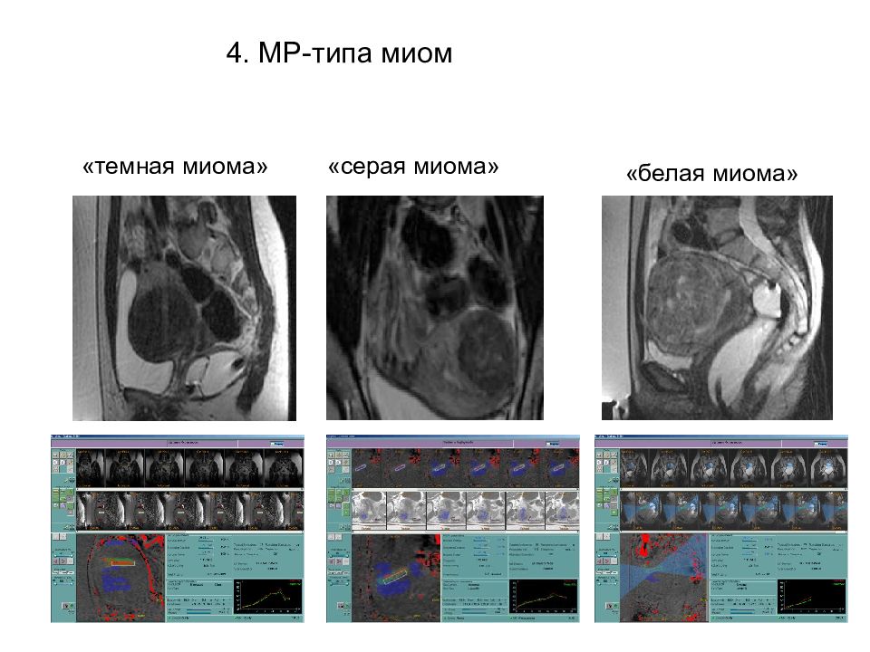 Миома матки мрт картина