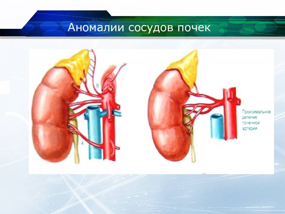 Аномалия развития почек презентация