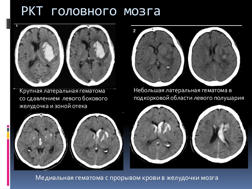 Геморрагический инсульт картинки