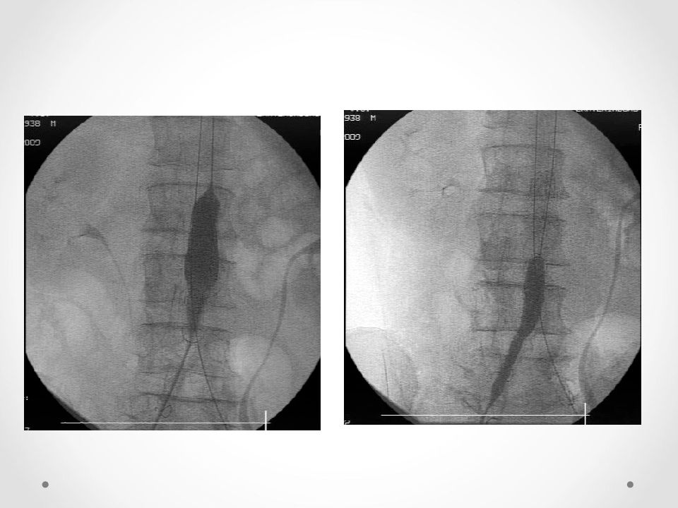 брюшная аорта рентген