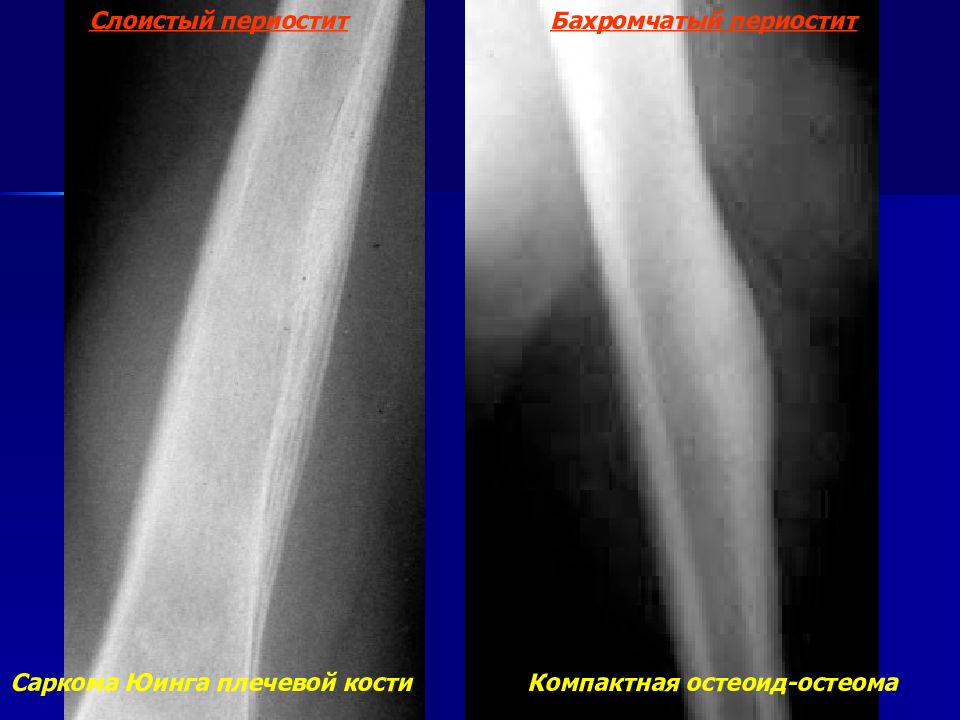 Периостит голени. Эндооссальная остеома. Опухоли большеберцовой кости остеома. Периостит плечевой кости. Бахромчатый периостит.