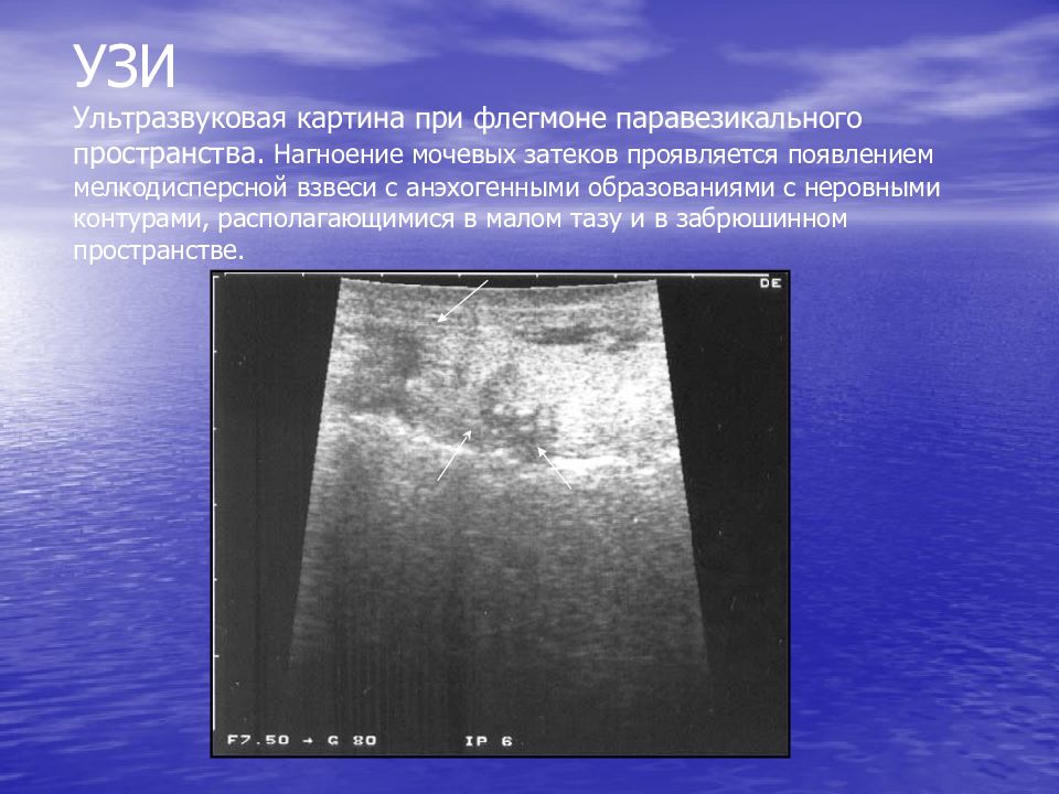 Ультразвуковое исследование органов забрюшинного пространства. Образования забрюшинного пространства на УЗИ. Забрюшинное пространство УЗИ. Флегмона мягких тканей на УЗИ. Забрюшинная флегмона УЗИ.