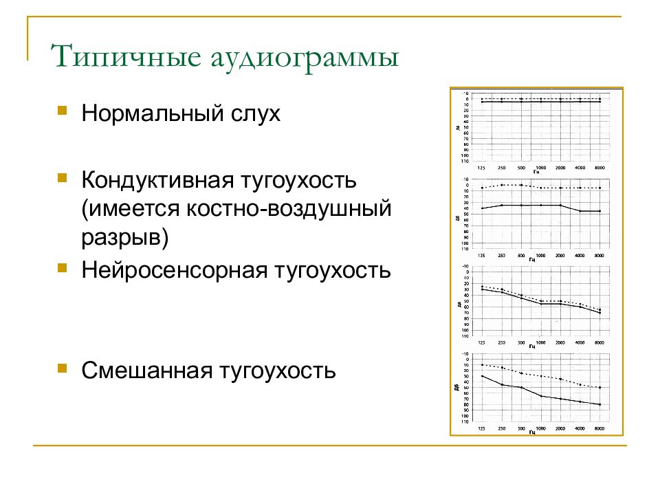 Аудиограмма в норме рисунок