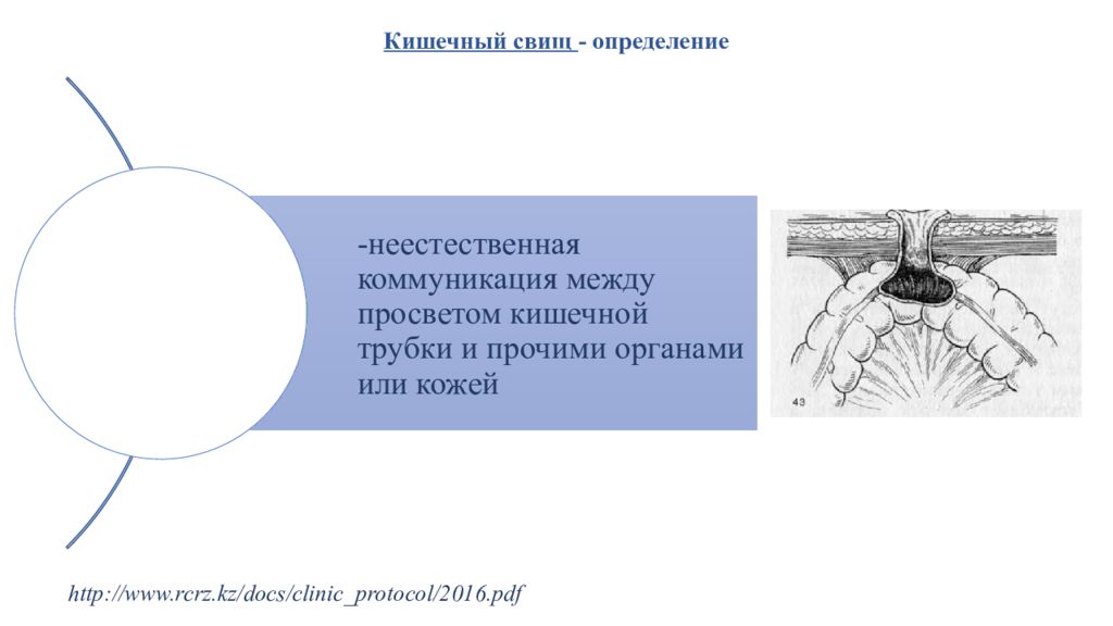 Ректовагинальный свищ по утвержденным клиническим рекомендациям 2022. Несформированные кишечные свищи.