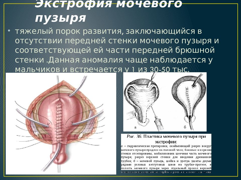 Аномалии мочеполовой системы презентация