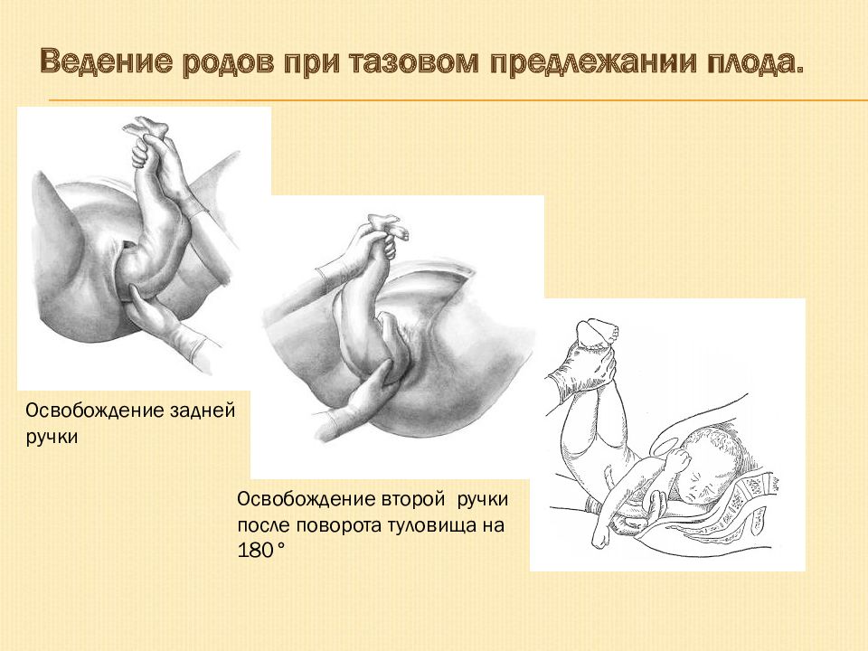 Тазовое предлежание картинки