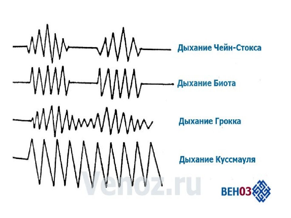 Дыхание чейна стокса схема