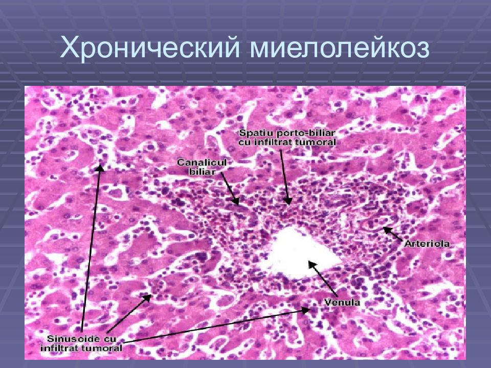 Гемобластозы патологическая анатомия презентация