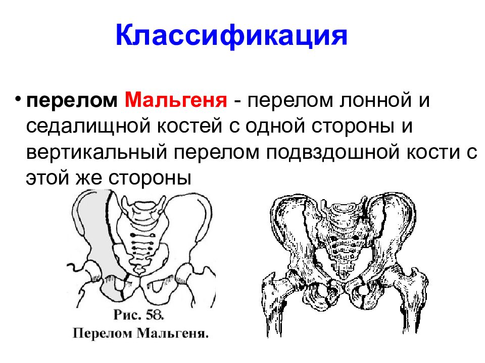 Седалищный лобковой кости