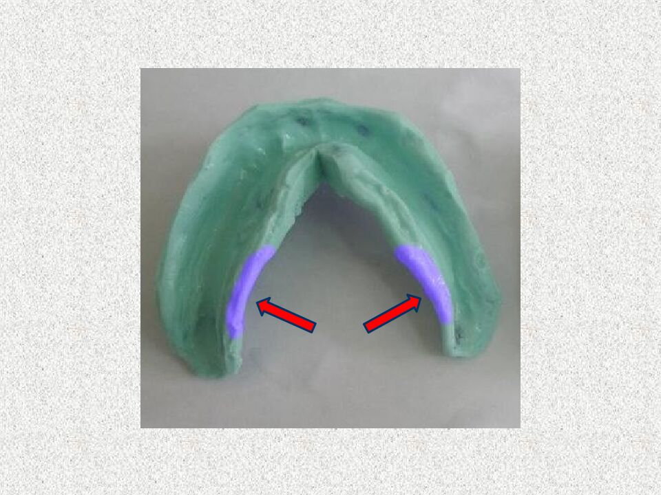 Funksional otisklar uchun individual qoshiqchalar