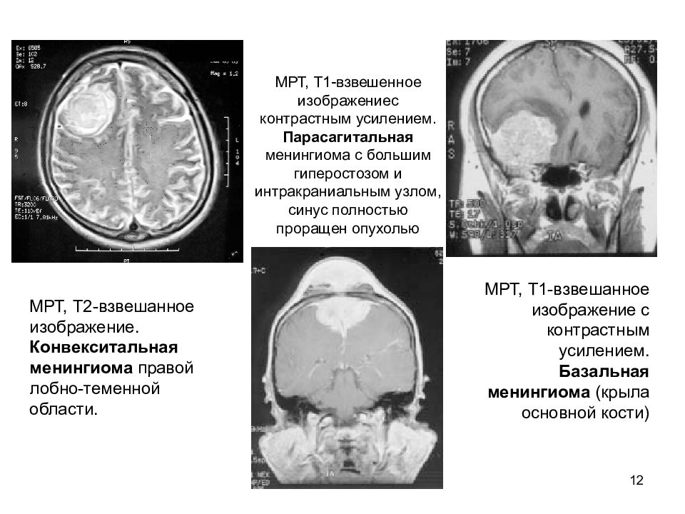 Опухоли цнс презентация