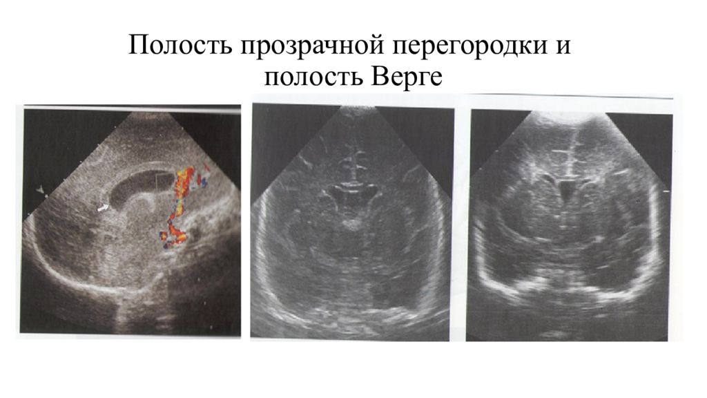 Полость расширена. Киста полости Верге УЗИ. Полость Верге у новорожденного на УЗИ. Полость прозрачной перегородки НСГ. Киста полости прозрачной перегородки на УЗИ.