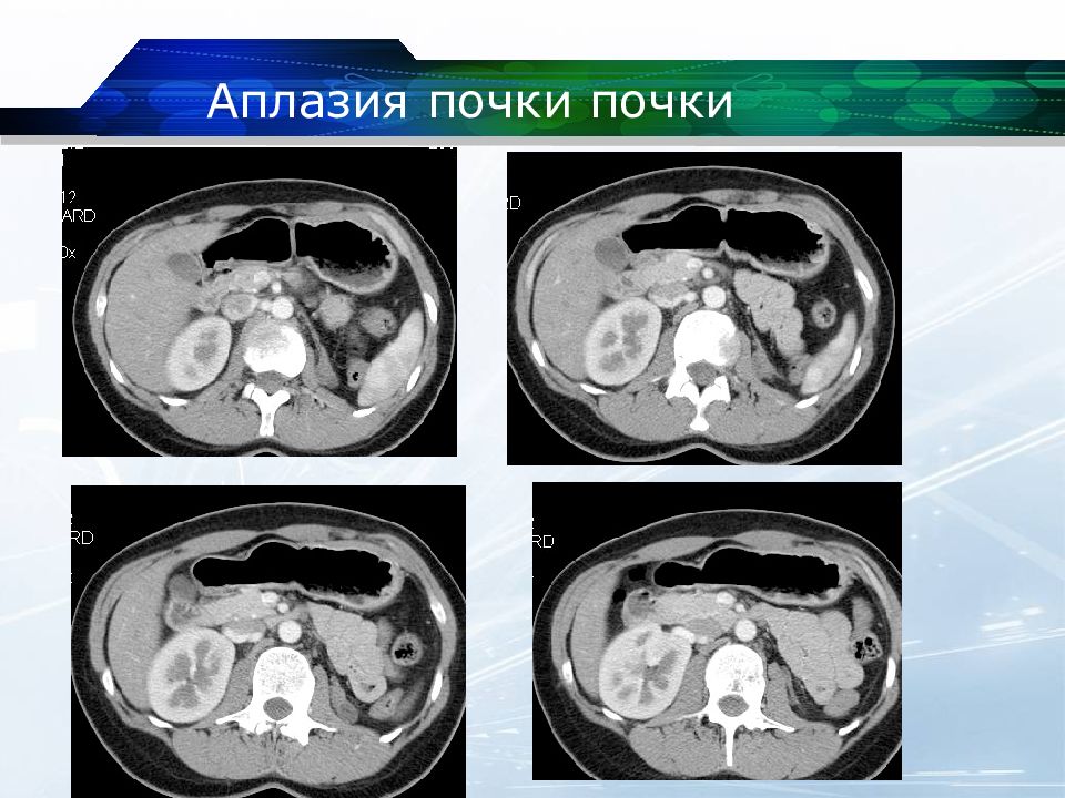 Кт почек презентация