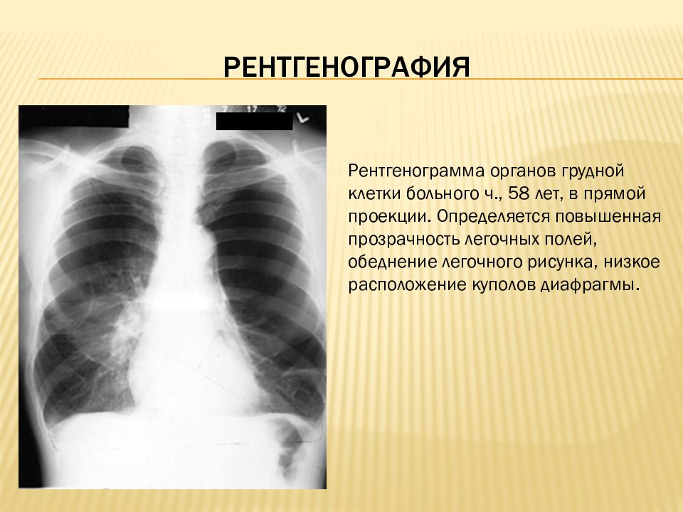 Методы лучевой диагностики органов дыхания презентация