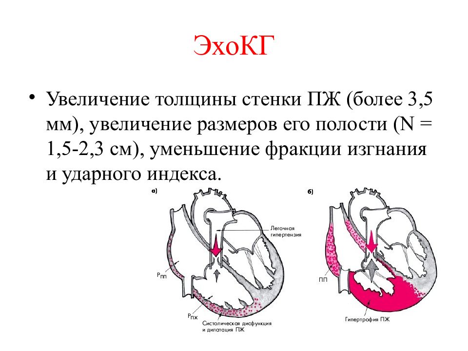 Легочное сердце картинки