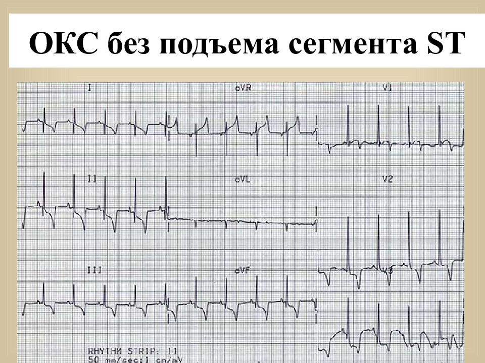 Карта вызова смп инфаркт миокарда без подъема сегмента st