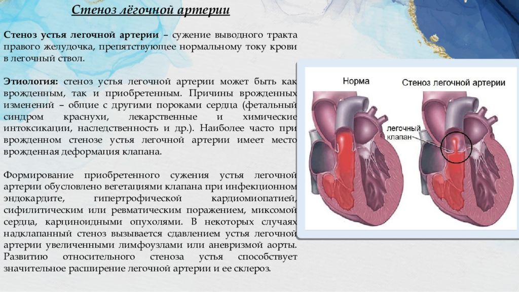 Сколько живут с пороком сердца приобретенным