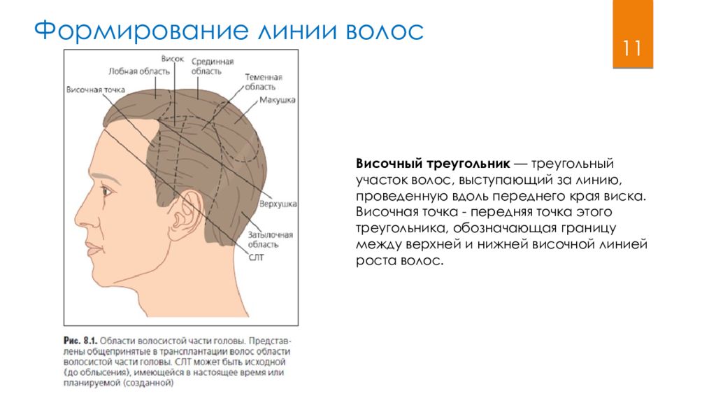 Линия волос. Височная линия волосы. Линия волос треугольник. Оценочная линия волос. Части участков волос.