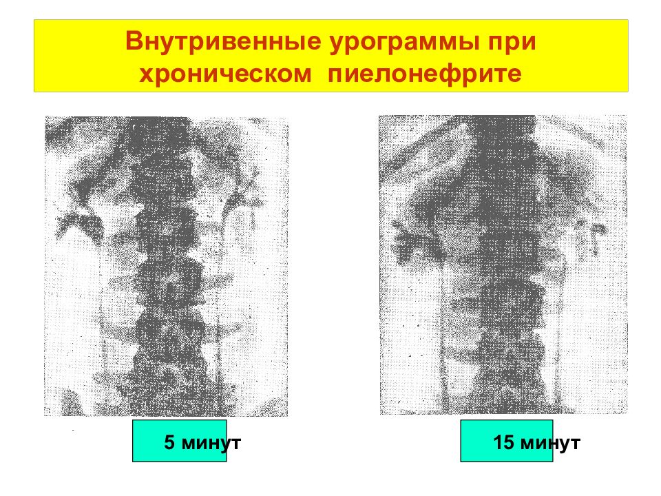 Хронический пиелонефрит у детей презентация