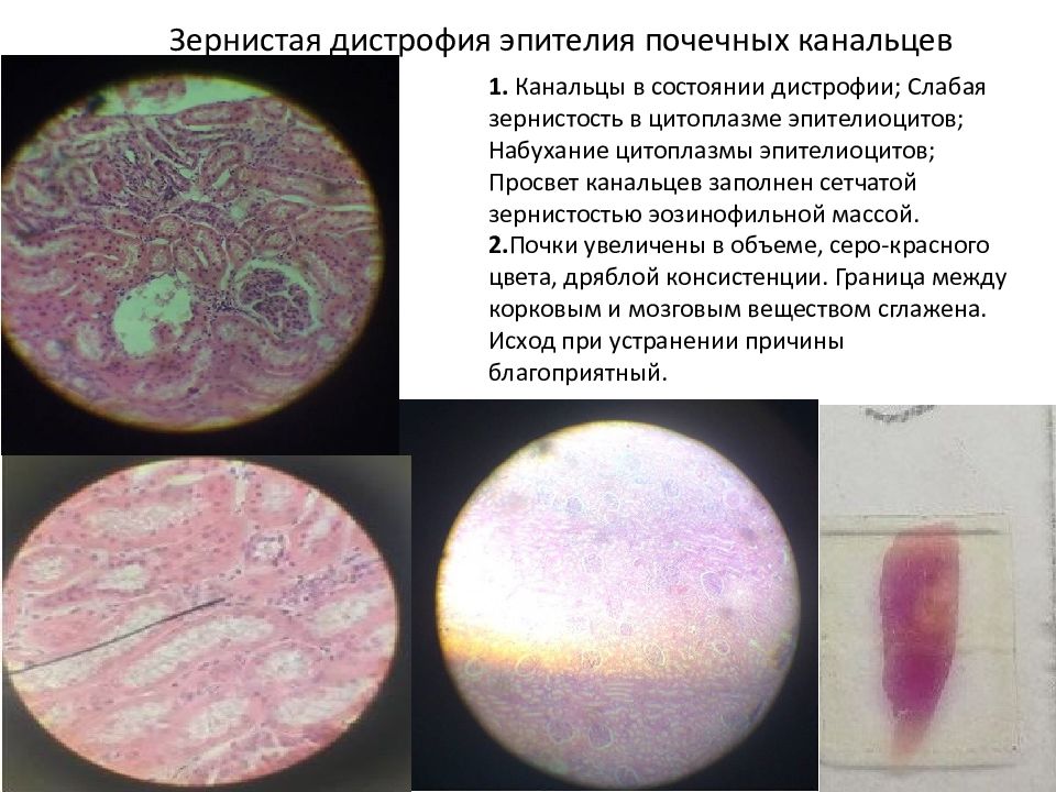 Зернистая дистрофия. Зернистая дистрофия почек. Зернистая дистрофия эпителия почечных канальцев.