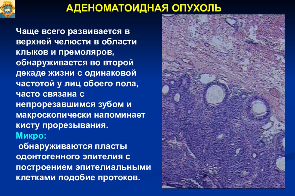 Частые опухоли. Аденоматоидная опухоль гистология. Аденоматоидная одонтогенная опухоль. Аденоматоидная опухоль челюсти. Аденоматоидная опухоль яичка.