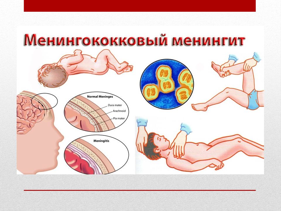 Менингит последствия. Менингококк назофарингит. Менингококковая инфекция назофарингит синдромы. Менингококковая инфекция симптомы патогенез. Менингококковый менингит клинические.