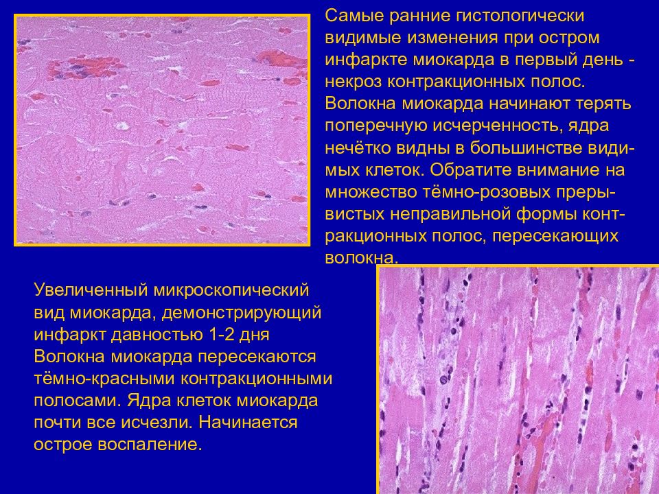 Инфаркт миокарда патологическая анатомия презентация