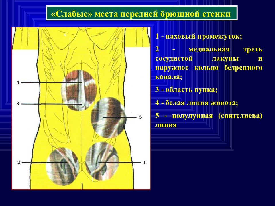 Грыжа мышцы. Полулунная линия (спигелиева линия) образуется. Грыжи спигелиевой линии живота топографическая анатомия. Грыжа переднебоковой стенки. Слабые места передней брюшной стенки грыжи.