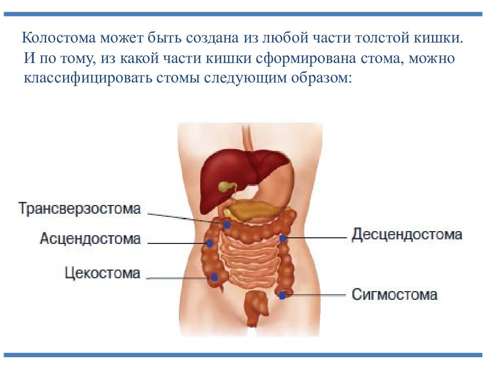 Презентация стомы и их виды