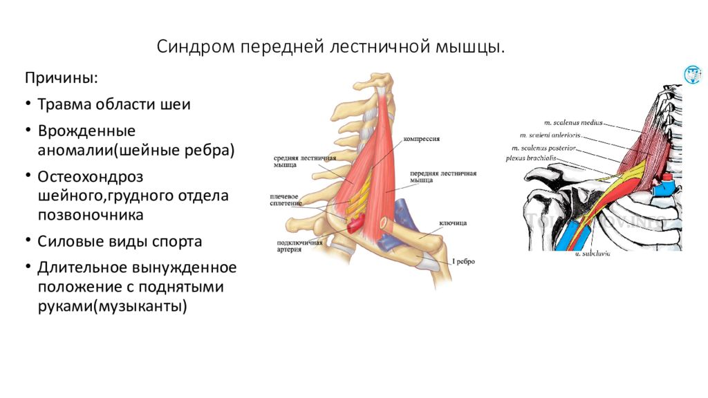 Переднюю. Синдром передней лестничной мышцы. Шейный остеохондроз синдром лестничной мышцы. Синдром передних лестничных мышц. Спазм лестничных мышц шеи.