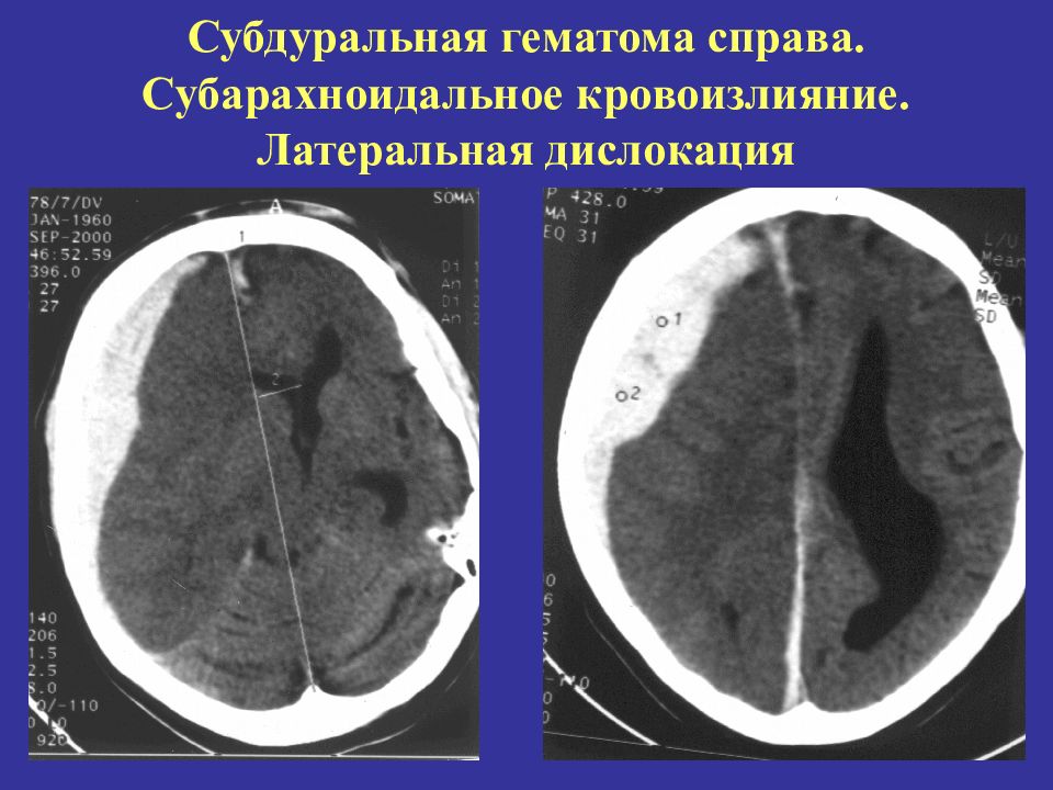 Субдуральное кровоизлияние это. Субдуральная и эпидуральная гематома кт. Субдуральное кровоизлияние головного мозга на кт. Субдуральная и эпидуральная гематома мрт. Острая субдуральная гематома кт.