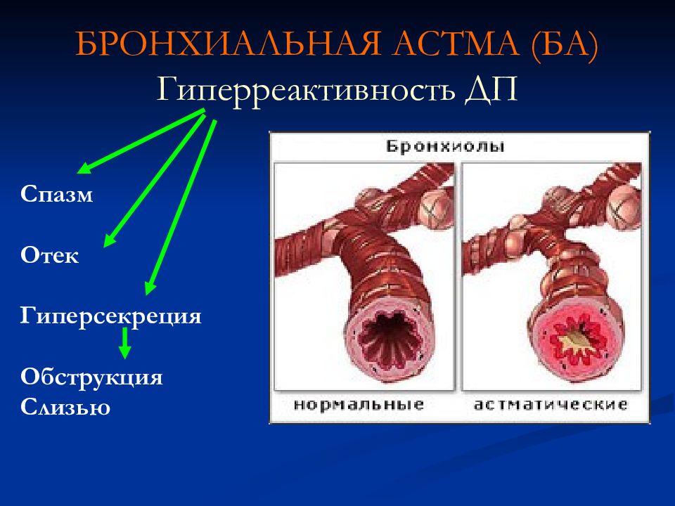 Бронхиальная астма в картинках